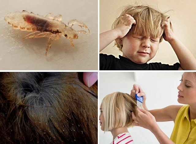 Профилактика вшей у человека - фото