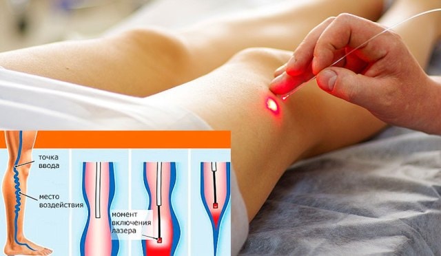 Сосудистые «сеточки» на ногах: причины и лечение, фото1