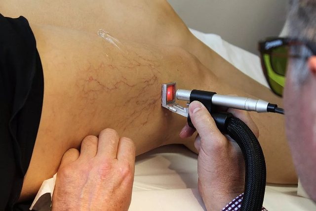 Сосудистые «сеточки» на ногах: причины и лечение, фото4