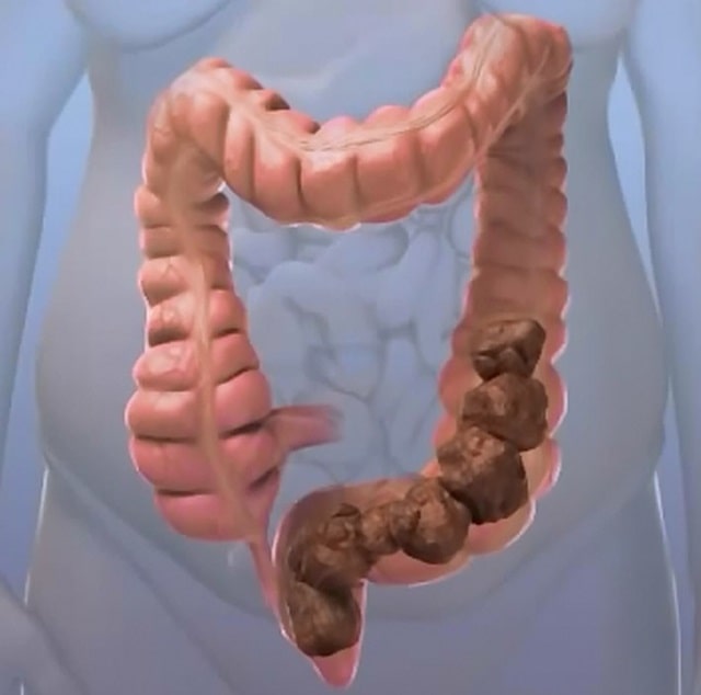 Запор: что это такое, причины, симптомы, профилактика - фото1 Запор: что это такое, причины, симптомы, профилактика - фото1