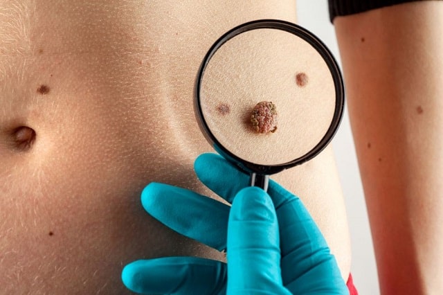Злокачественная родинка: что это такое, особенности, как распознать и что делать - фото1