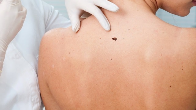 Злокачественная родинка: что это такое, особенности, как распознать и что делать - фото4