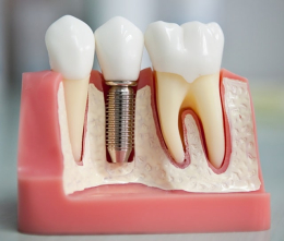 Как проходит имплантация зубов: этапы и особенности