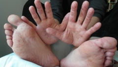 Корь в Донецкой области: недуг диагностировали у военнослужащего