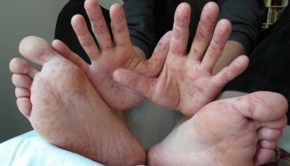 Корь в Донецкой области: недуг диагностировали у военнослужащего