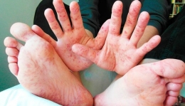 На Донетчине – новые случаи кори