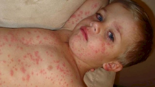 Только в Мариуполе с начала года 130 детей заболели корью