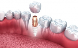 Одномоментная имплантация зубов: когда можно обратиться к процедуре