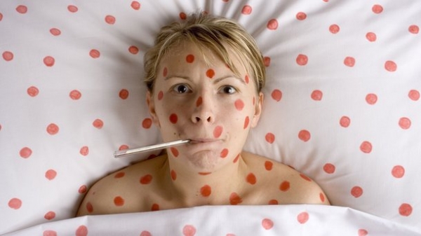 Корь не отступает: в Мариуполе зафиксированы два случая коревой пневмонии