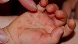 На Донетчине зарегистрированы новые случаи кори