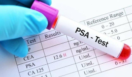 Індекс вільного ПСА: що це і як допомагає у діагностиці простати