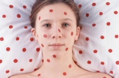 Зафиксирован новый случай кори, больная – переселенка из прифронтового города