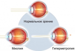 Близорукость и дальнозоркость: что это такое, отличия, причины возникновения