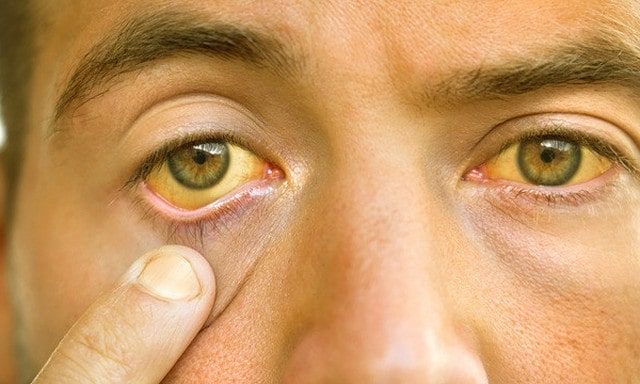 На оккупированной территории Донбасса – вспышка гепатита